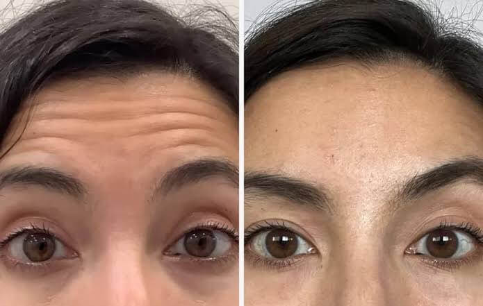 Botox Injections